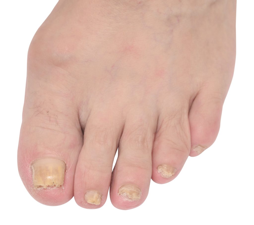 Fungal Toenails Treatment - Austin Foot & Ankle Center