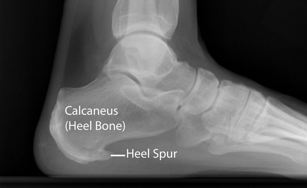 Is That a Heel Spur — or Plantar Fasciitis?: North Central Texas
